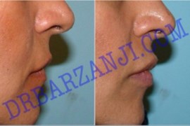 تزریق ژل جوویدرم در لب 