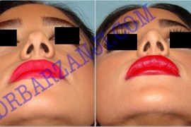 جراحی بینی،ترمیم