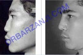 جراحی ترمیمی بینی