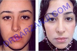 ترمیم بینی