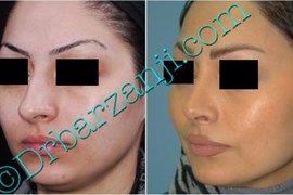 عمل جراحی پلاستیک بینی ( رینوپلاستی )