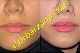 تزریق ژل در لب ها