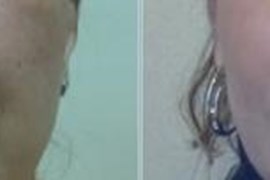 تزریق ژل  در خط خنده
