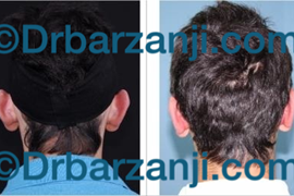 جراحی ترمیمی برجستگی لاله گوش