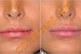 تزریق ژل جوویدرم  ( ژوویدرم ) به لب یک ماه بعد