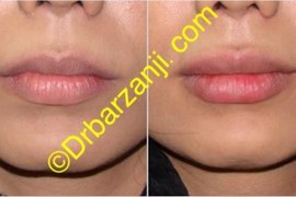 تزریق ژل ژوویدرم به لب