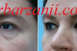 تزریق ژل رستیلن زیر چشم ها- شش ماه بعد
