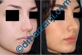 جراحی بینی یک سال و نیم بعد از عمل