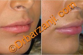 تزریق ژل جوویدرم  ( ژوویدرم ) به لب یک ماه بعد