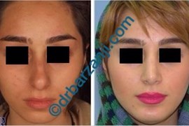  جراحی بینی و پروتز چانه چهار سال بعد از عمل