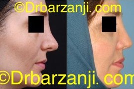 جراحی ترمیمی بینی شش سال بعد از عمل