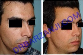 جراحی بینی، شش ماه بعد از عمل