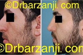 جراحی بینی دو سال بعد از عمل