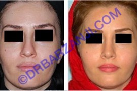 جراحی پلاستیک بینی، 4 سال بعد