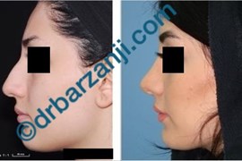 جراحی بینی یک سال و نیم بعد از عمل