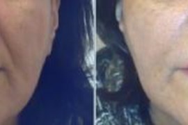 تزریق ژل  در خط خنده
