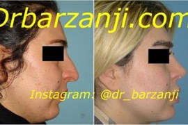 جراحی بینی و پروتز چانه