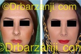 عمل جراحی زیبایی بینی یک سال بعد