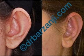جراحی برجستگی لاله گوش