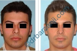 جراحی بینی و پروتز چانه 6 ماه بعد از عمل
