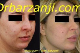 پروتز چانه و زاویه فک