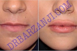 ژل  جوویدرم در لب بالا و پایین، ٥ هفته بعد