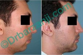 پروتز چانه دو هفته بعد از عمل