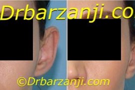 جراحی برجستگی لاله گوش