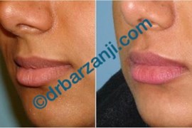 تزریق ژل جوویدرم در لب