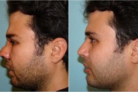 پارگی و شکستگی بینی 1