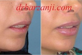 تزریق ژل جوویدرم در لب