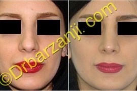 جراحی بینی سه ماه بعد از عمل