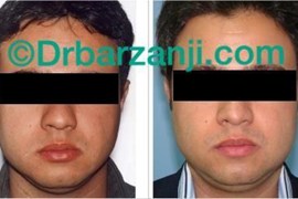 تزریق چربی در ناحیه فک پایین سمت چپ