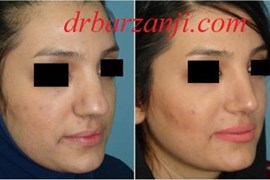 جراحی بینی کج