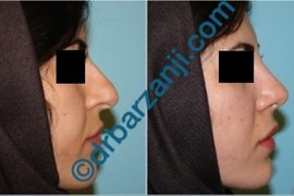 جراحی بینی یک ماه بعد از عمل