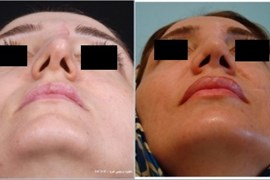 جراحی ترمیمی بینی
