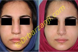 جراحی بینی گوشتی یک سال بعد از عمل