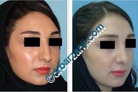  جراحی پلاستیک بینی یک سال بعد از عمل