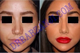 جراحی بینی،ترمیم