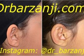 جراحی زیبایی لاله گوش برجسته