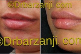 تزریق ژل جوویدرم  (ژوویدرم )در لب ، 9 ماه بعد