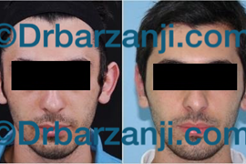 جراحی ترمیمی برجستگی لاله گوش