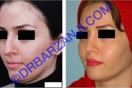 پروتز گونه و جراحی بینی