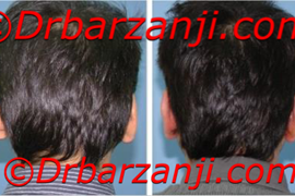 جراحی برجستگی گوش یک ماه بعد از عمل