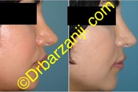 تزریق ژل رستیلن در بینی عمل شده
