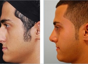 جراحی بینی اولیه