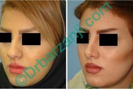جراحی پلاستیک بینی شش ماه بعد از عمل