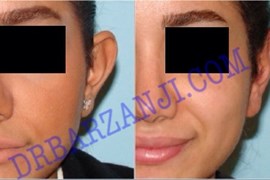 جراحی پلاستیک برجستگی لاله گوش چپ