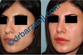 جراحی بینی یک ماه بعد از عمل