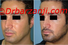 پروتز چانه یک هفته بعد از عمل